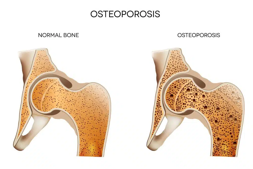 Mengapa Osteoporosis Bisa Terjadi?