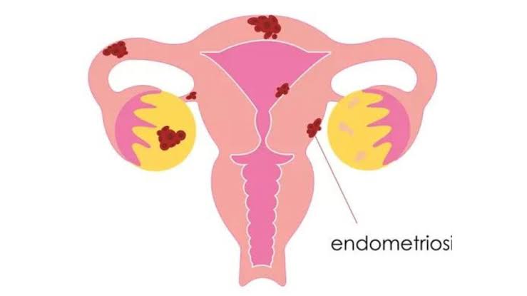 Apa Itu Endometriosis? Kenali 9 Gejala, Risiko, Komplikasi, dan Terapinya