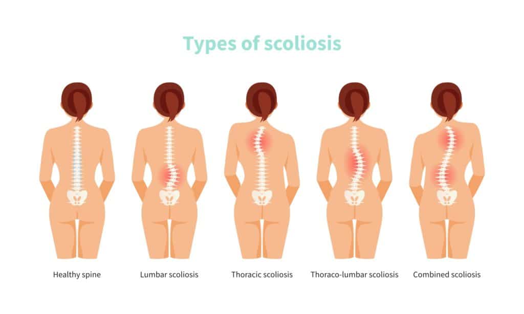 Tanda dan Gejala Osteoporosis yang Perlu Dikenali